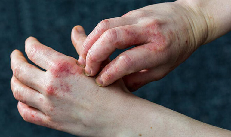 Bệnh Chàm Eczema