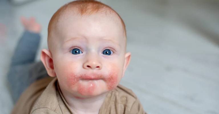Bé sơ sinh bị nổi mẩn đỏ ở mặt là bệnh gì? Nguy hiểm không?