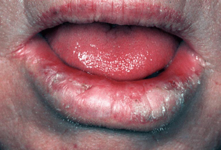 Ngủ dậy bị sưng môi có nguy hiểm không?