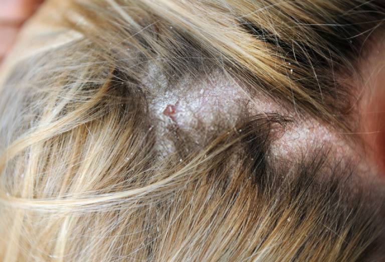 Có nên điều trị nấm da đầu bằng Đông y không? 
