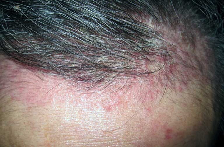 Nấm da đầu lan xuống mặt có nguy hiểm không?