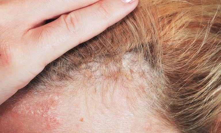 Phương pháp điều trị nấm và vảy nến da đầu