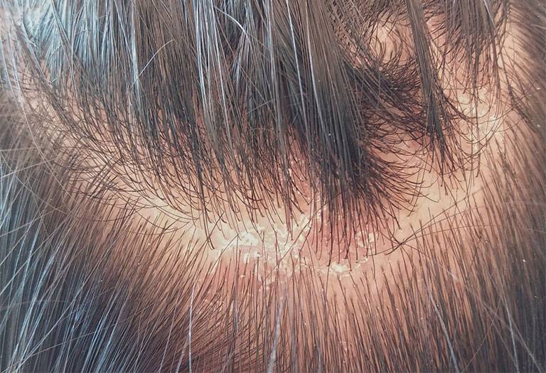 Nấm da đầu gây ngứa và rụng tóc