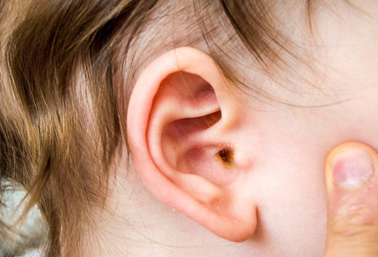 Dấu hiệu nhận biết viêm tai giữa